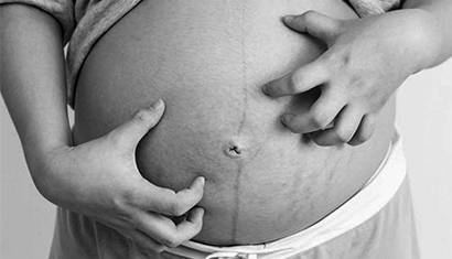 PUPPP: Ernstige jeuk tijdens de zwangerschap